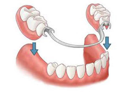 Dentalsancak Protetik Tedavi